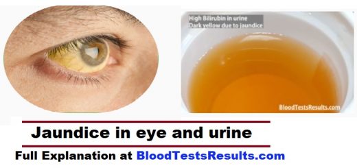 jaundice bilirubin look in urine and eyes