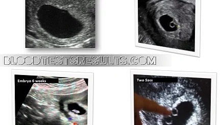 blighted-ovum-hcg-levels-ultrasound