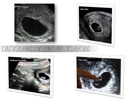 blighted-ovum-hcg-levels-ultrasound