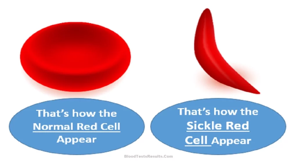 Normal red blood cell compared to the shape of the sickled red blood cell