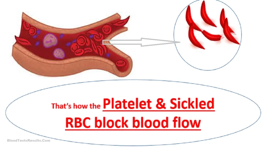Shows how Sickle RBCs and high  platelets clogging the blood vessel and block the blood flow