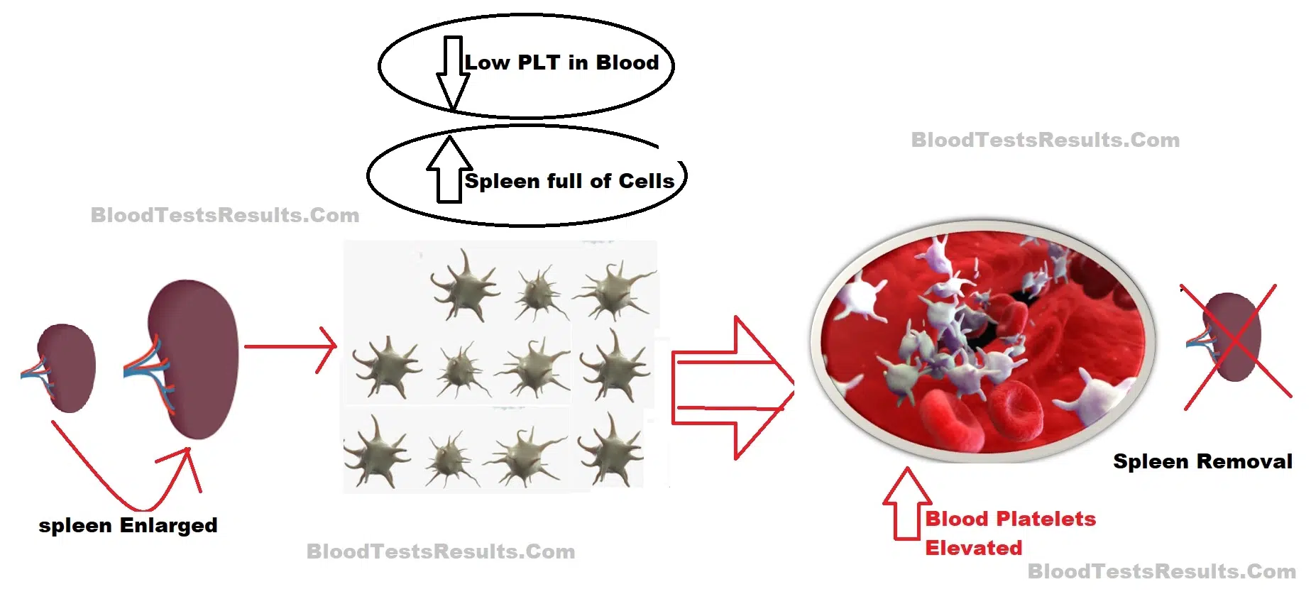 drawing shows how does thrombocytosis occurs post spleen surgery