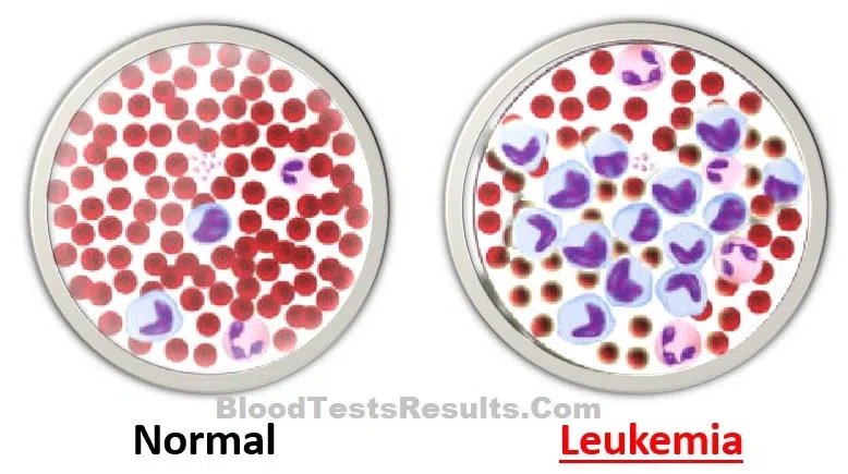 comparison, normal cells count shows normal wbc, plr, rbc vs leukemic count shows too much wbc that suppress platelets count