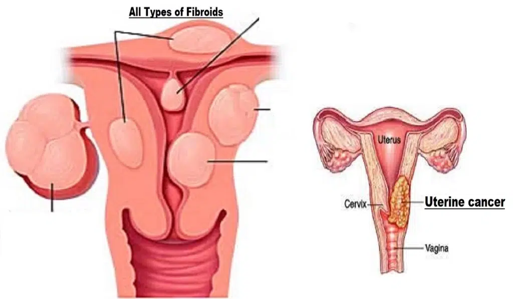 in uterine, illustration of fibroid types vs cancers